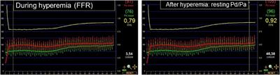 The pressure-derived microvascular resistance reserve and its correlation to Doppler MRR measurement—a proof of concept study